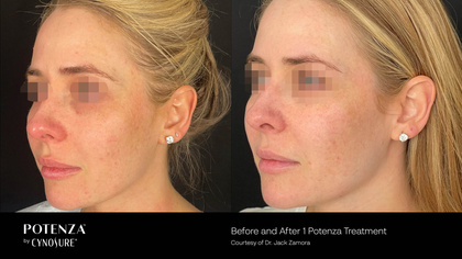 Potenza treatment results